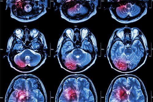 MRI-Imagen-secciones-del-cerebro-humano