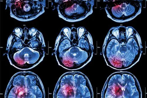 Imágenes por resonancia magnética: una gran ayuda para el diagnóstico médico MRI-Imagen-secciones-del-cerebro-humano