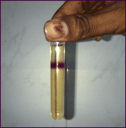 Un tubo de ensayo que contiene un conjunto de solución de muestra para la prueba de Rothera. La presencia de un anillo de color púrpura permanganato indica un resultado positivo